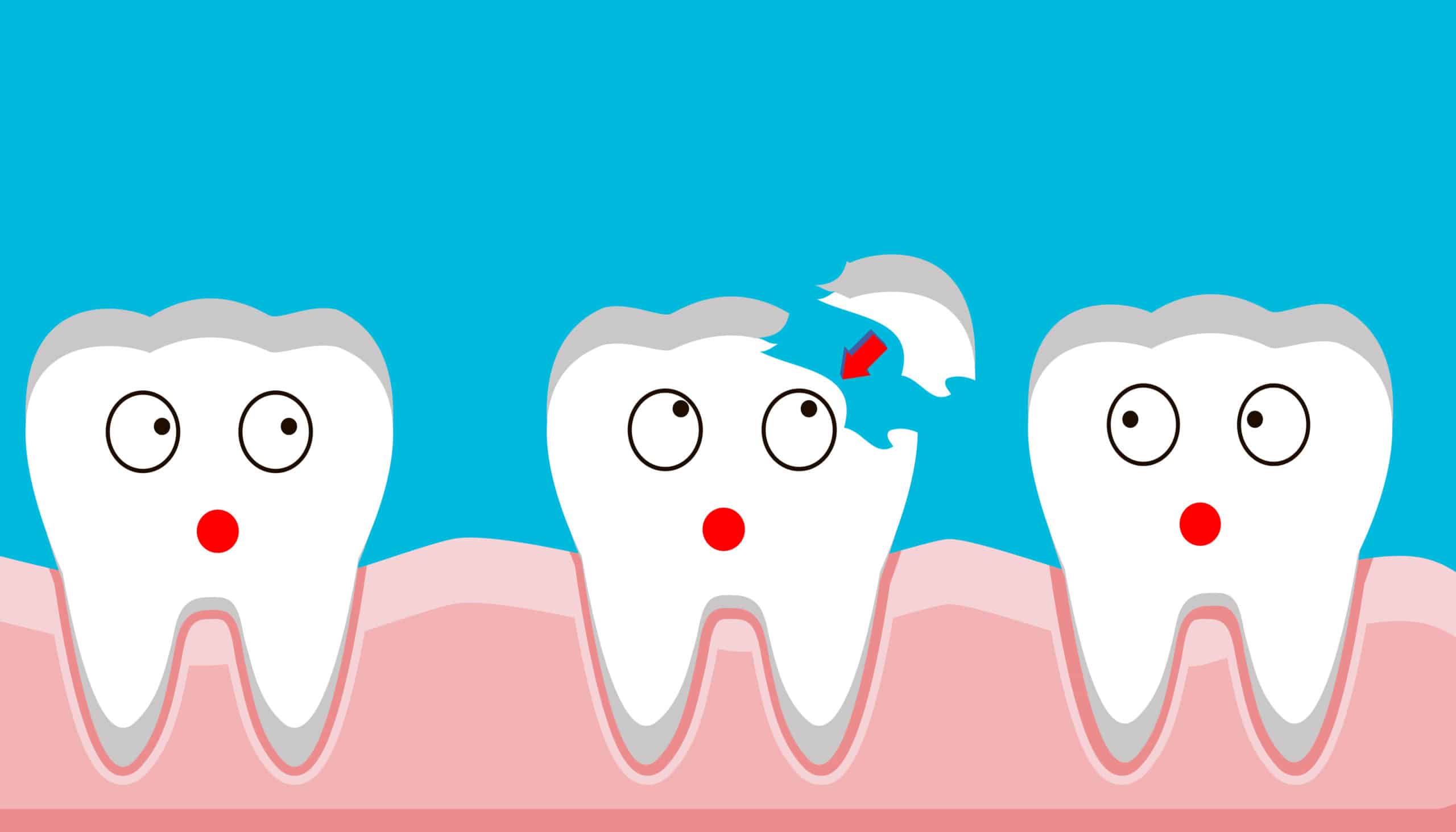 Illustration Of Cracked Tooth Repair Smile Mouth With Cracked